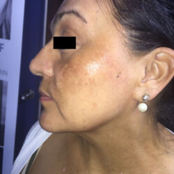 Just prior to the 3rd treatment for melasma Left facial profile